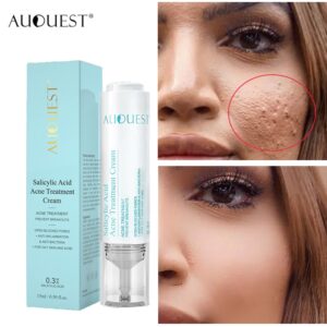 Creme facial acne ácido salicílico, AUQUEST, Clareamento Tratamento Facial, Ácido Hialurônico, Pontos Pretos, Remover Cuidados Com A Pele, Beleza Saúde