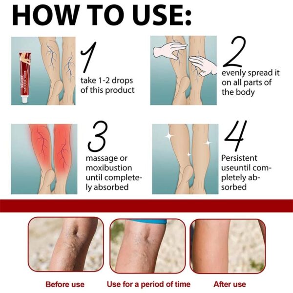 Creme para pernas, varizes, de ervas creme alívio vasculite flebite aranha, da dor, pomada erva gesso beleza corpo pernas cuidados 20g - Image 6