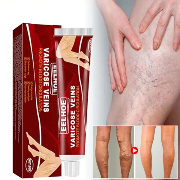 Creme para pernas, varizes, de ervas creme alívio vasculite flebite aranha, da dor, pomada erva gesso beleza corpo pernas cuidados 20g