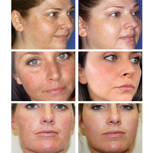Creme facial de Sardas, de Clareamento Eficaz, Melasma Remover Manchas Escuras, Melanina, Hidratar, Iluminar o Rosto Suave, Cuidados Com A Pele - Image 3