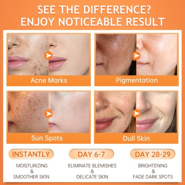 Creme facial removedor de mancha escura, Vitamina C, Clareamento, Produtos De Cuidados Com A Pele Para Rosto VC Clareamento Pele Preta Acne Mark Melanina - Image 4