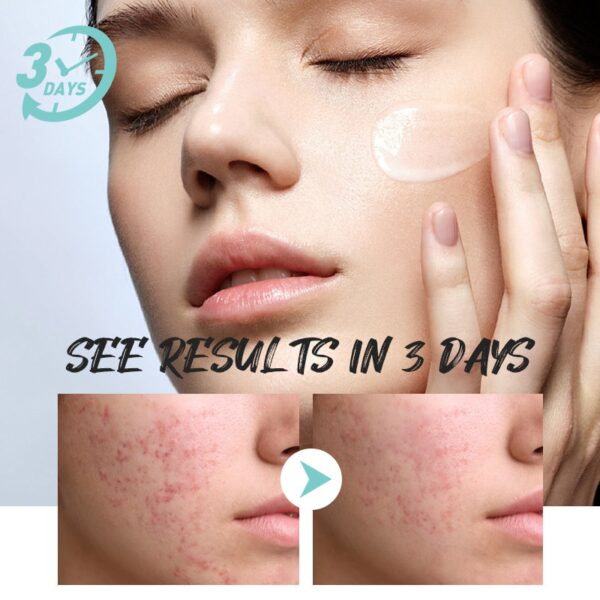 Loção tratamento facial, Caracol Essência, Reparação, Vermelhidão, Pele Seca, Sensível, Hidratante Intenso, Sooth, Cosméticos Korean Care - Image 5