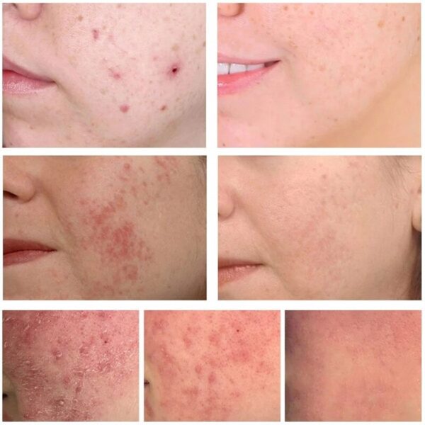 Loção tratamento facial, Caracol Essência, Reparação, Vermelhidão, Pele Seca, Sensível, Hidratante Intenso, Sooth, Cosméticos Korean Care - Image 4