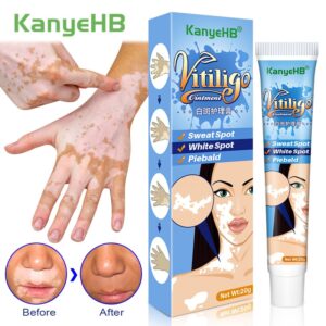 Creme/pomada, Herbal Vitiligo extrato, Remover Micose, Remoção de mancha branca, Pele mancha branca, Leucoplasia doença tratamento creme, 20g
