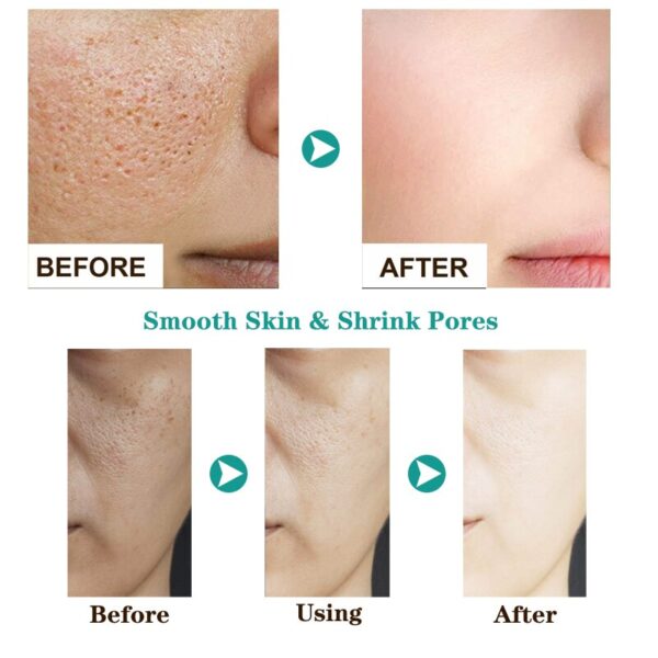 Creme facial acne ácido salicílico, AUQUEST, Clareamento Tratamento Facial, Ácido Hialurônico, Pontos Pretos, Remover Cuidados Com A Pele, Beleza Saúde - Image 2