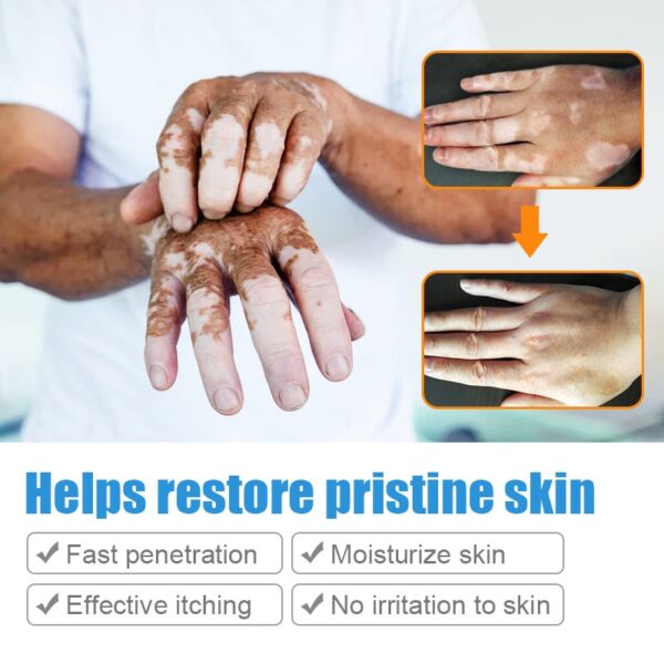 Creme/pomada, Herbal Vitiligo extrato, Remover Micose, Remoção de mancha branca, Pele mancha branca, Leucoplasia doença tratamento creme, 20g - Image 4