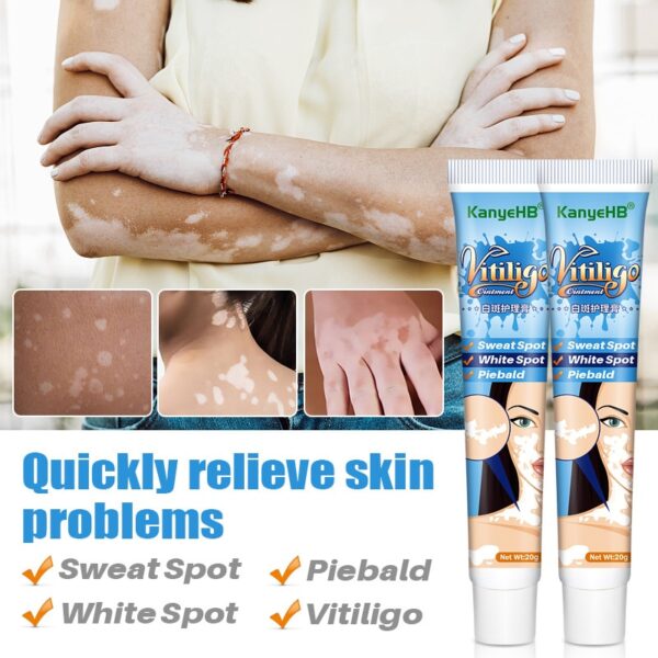 Creme/pomada, Herbal Vitiligo extrato, Remover Micose, Remoção de mancha branca, Pele mancha branca, Leucoplasia doença tratamento creme, 20g - Image 3