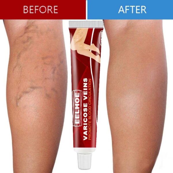 Creme para pernas, varizes, de ervas creme alívio vasculite flebite aranha, da dor, pomada erva gesso beleza corpo pernas cuidados 20g - Image 2