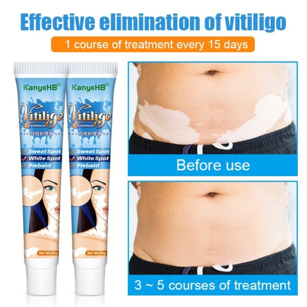Creme/pomada, Herbal Vitiligo extrato, Remover Micose, Remoção de mancha branca, Pele mancha branca, Leucoplasia doença tratamento creme, 20g - Image 2