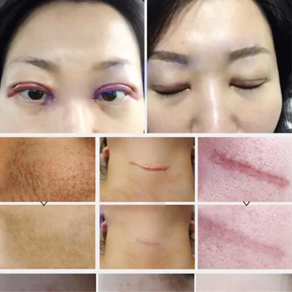 Creme de remoção rápida cicatriz, Reparação de estrias, Queimar Cirurgia, Tratar Gel, Acne, Pox, Pomada, Cuidados com a pele suave - Image 2