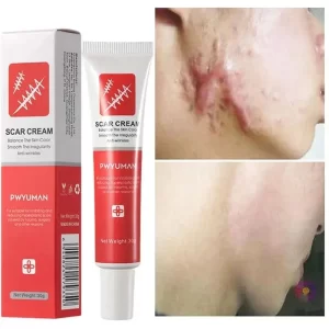 Creme de remoção rápida cicatriz, Reparação de estrias, Queimar Cirurgia, Tratar Gel, Acne, Pox, Pomada, Cuidados com a pele suave