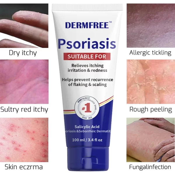 Creme Antibacteriano Psoríase, Pomada Eczema, Tratamento da Pele, Dermatite, Odor do Pé comichão, Erva-Medicina, Cuidados Psoríase, 100ml por g