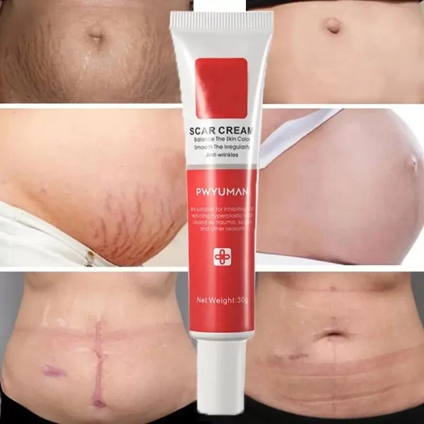Creme de remoção rápida cicatriz, Reparação de estrias, Queimar Cirurgia, Tratar Gel, Acne, Pox, Pomada, Cuidados com a pele suave - Image 3