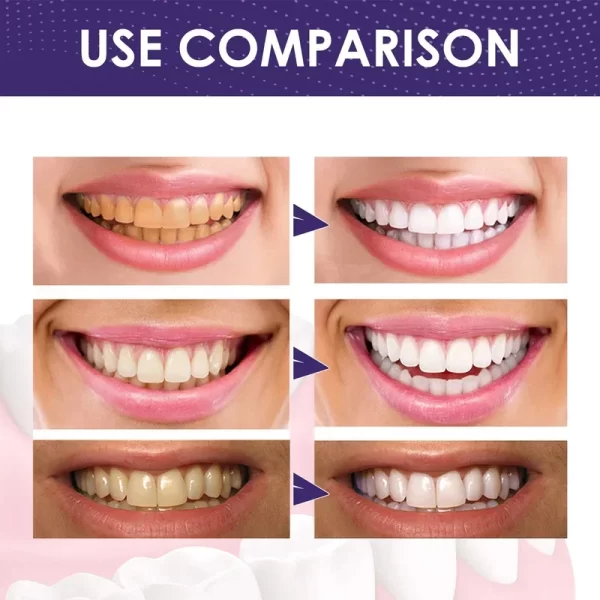 Creme dental, Dentes branqueamento, removedor rápido, manchas de placa, reparar cavidades, prevenir a periodontite, respiração fresca, iluminar, cuidados dentários - Image 3